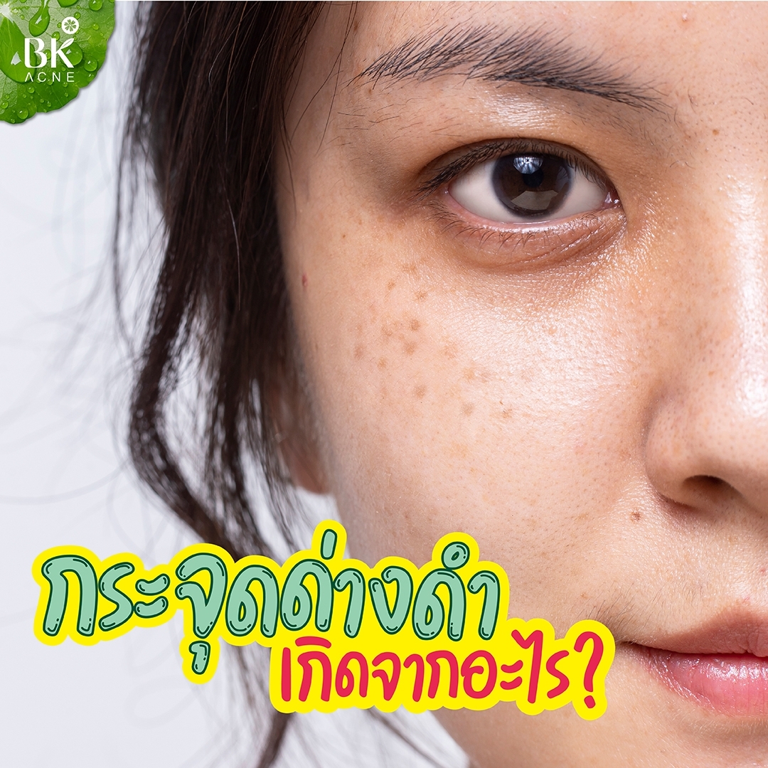 กระ จุดด่างดำเกิดจากอะไร